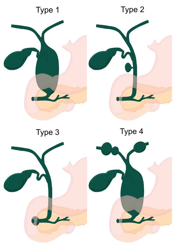 Choledochus malformaties - Galwegstudies